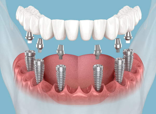 All on 4 Dental Implant Procedure