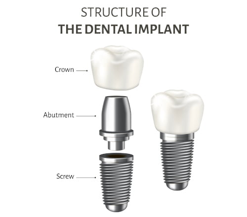 Dental Implants at Markham Smile Centre?