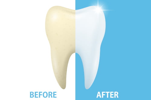 safe teeth whitening enamel protection dentist supervision