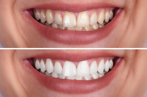 teeth whitening dentist Markham natural results professional care