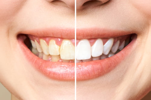ZOOM teeth whitening Markham in-office treatment fast results
