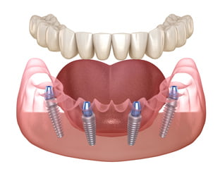 Illustration of an All-on-4 dental implant system supporting a full-arch prosthesis with four strategically placed implants.