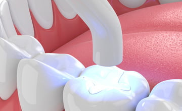 white non metal fillings