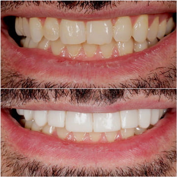 veneer on tooth