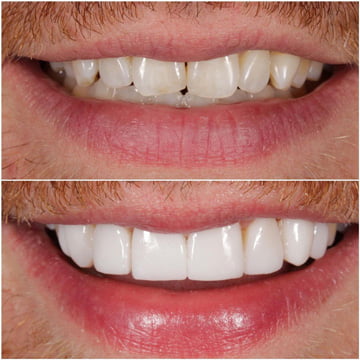 porcelain teeth veneers