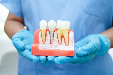 Dentist holding a single dental implant used to replace an individual missing tooth.