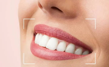 porcelain veneers