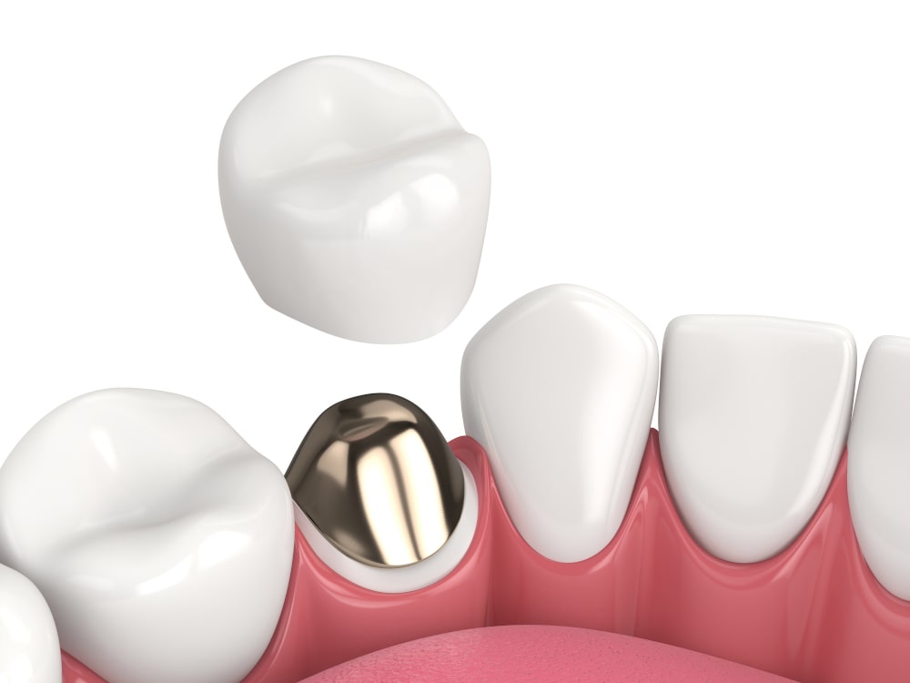 3D rendering of a dental crown with post and core in a lower jaw model