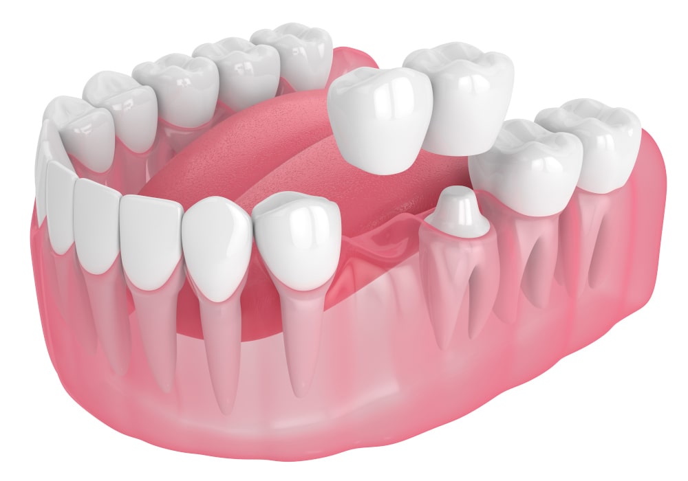 3D render of a cantilever dental bridge on a jaw model