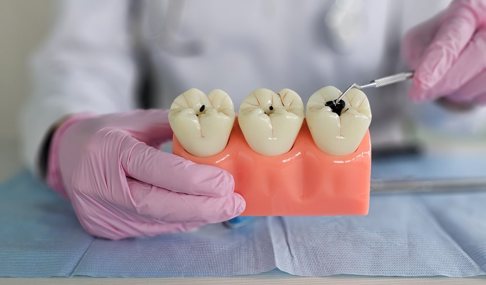 fluoride application for cavity prevention and enamel repair